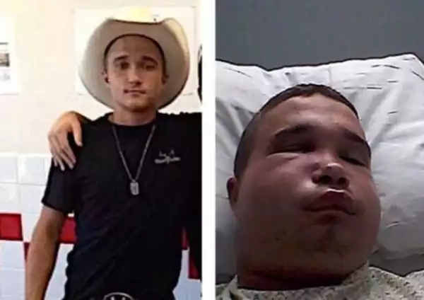 18-Year-Old Guy Gets Bit By A Snake While Kissing It.