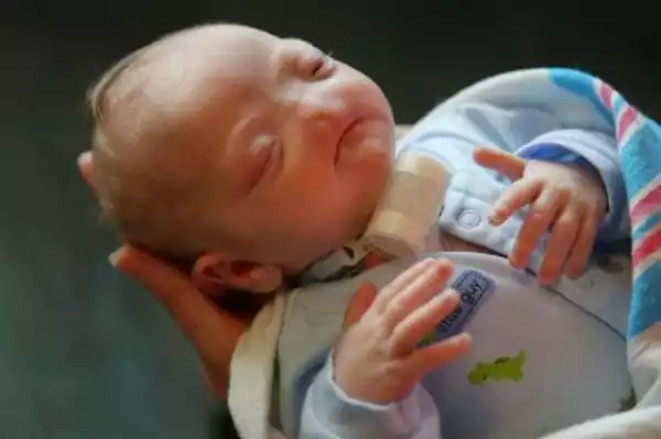 Baby Born With No Nose In Alabama