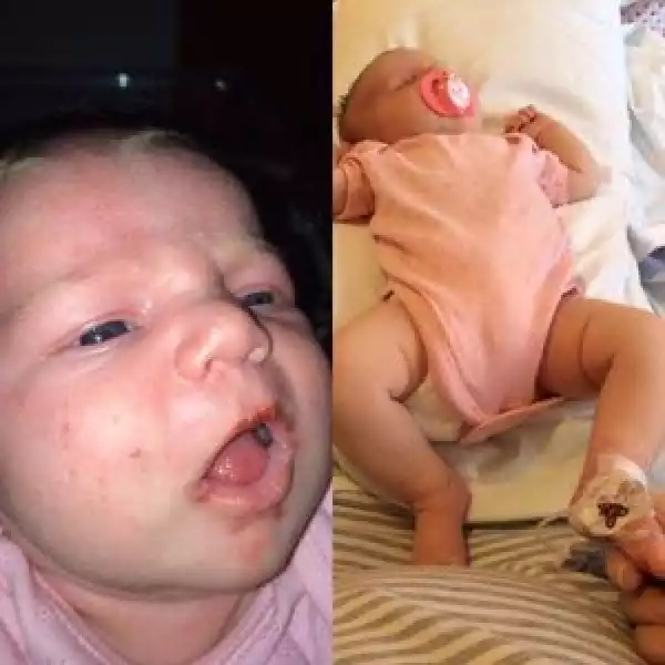 Baby Contracts Herpes After Family Member Kissed Her