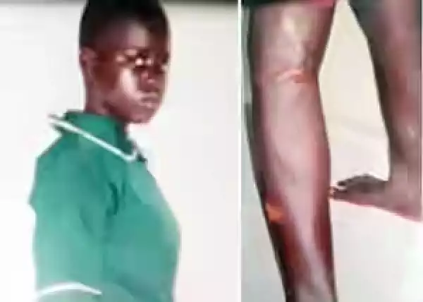 Father Cuts 17-Year-Old Daughter’s Leg With Hot Knife And Ran Away
