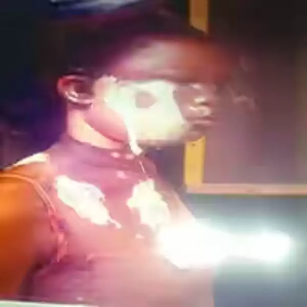 Graphic Photo: Apprentice Pours Hot Water On Colleague In Lagos 