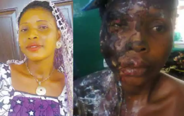 ‘Help! Don’t Let Me Die’ -Lady Bathed With Acid By Ex-Lover Cries Out