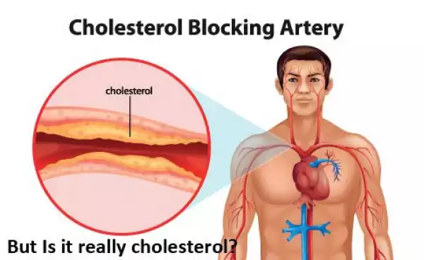 How To Clear Up Clogged Arteries & Eliminate Bad Cholesterol With This Natural Remedy