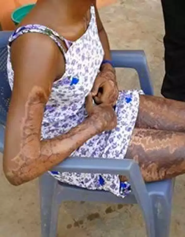 Man Pours Acid On His Girlfriend After His Pastor Told Him She Was Behind His Illness