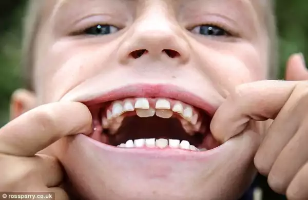 Meet 8-Year Old Boy Who Has Two Set of Teeth After Milk Teeth Fail To Fall Out| PHOTOS