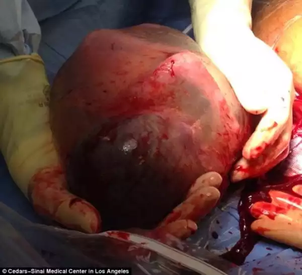 Perfectly healthy baby delivered still inside his amniotic sac