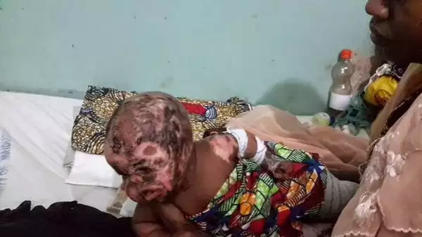 Photos: Baby Totally Disfigured After Boko Haram Attack (Burnt Face And Eye)