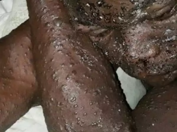 Strange Disease In Irele Not Contagious – Ondo Govt