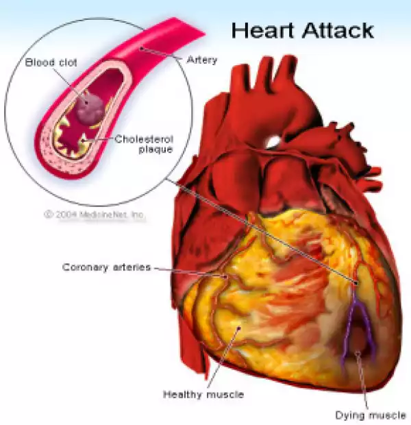 Why More People Die Of Heart Attack At Winter - S’cientists