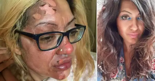 Mum left with skin peeling off her face after egg exploded during TikTok challenge