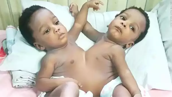 Inside Story Of How Twins Joined At The Chest And Abdomen Were Split In Nigeria (Photos)