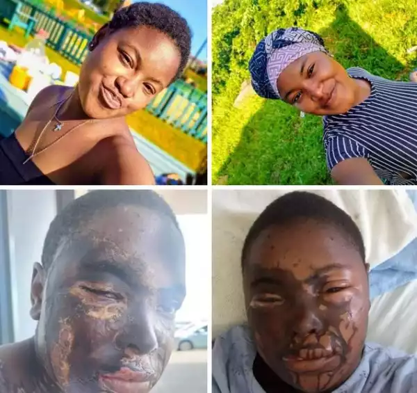 Woman Pours Acid On 18-year-old Girl In South Africa