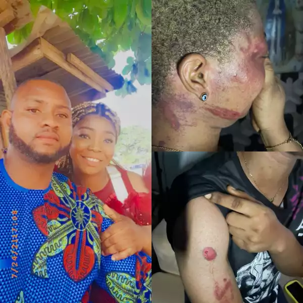 Woman Shows Horrific Injuries Allegedly Inflicted On Her Friend by Her Husband