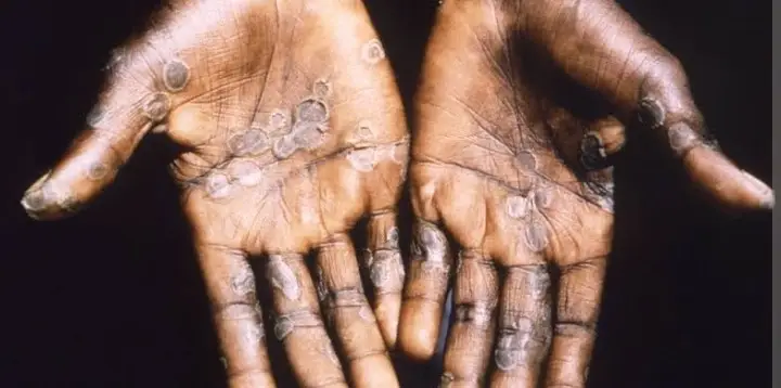 121Nigeria records eight deaths from 789 cases of mpox