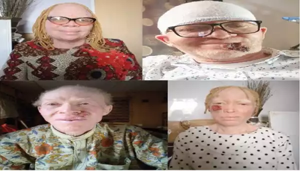 Ekiti albinos raise the alarm over deaths from skin cancer