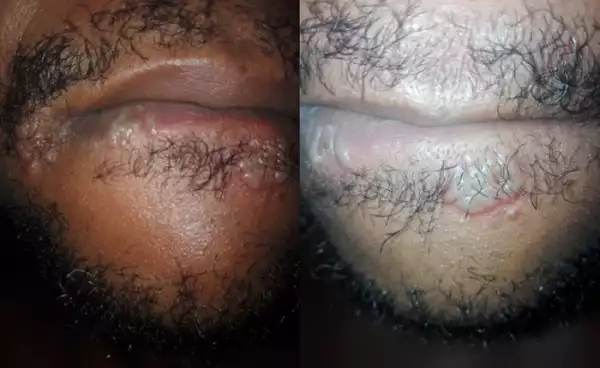GOBE!! Nigerian Man Shares Photos Of The Disgusting Sores Growing Around His Mouth After Performing Oral Sex On A Woman