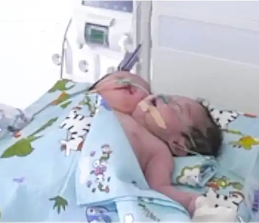 Doctors baffled as rare "two-headed" baby is born in Uzbekistan