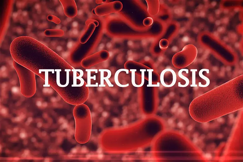 Bauchi detects 7,806 cases of tuberculosis