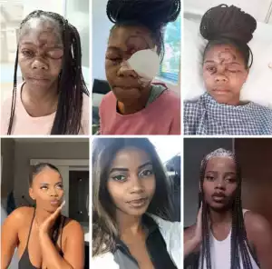 25-year-old South African Woman Loses Left Eye After Man Smashed Her Face With Brick For Rejecting His Advances