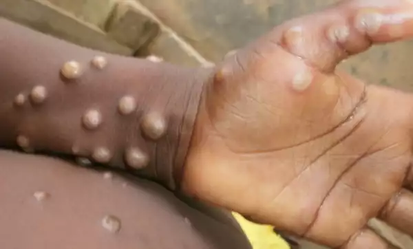 Monkeypox Cases Confirmed In Nigeria