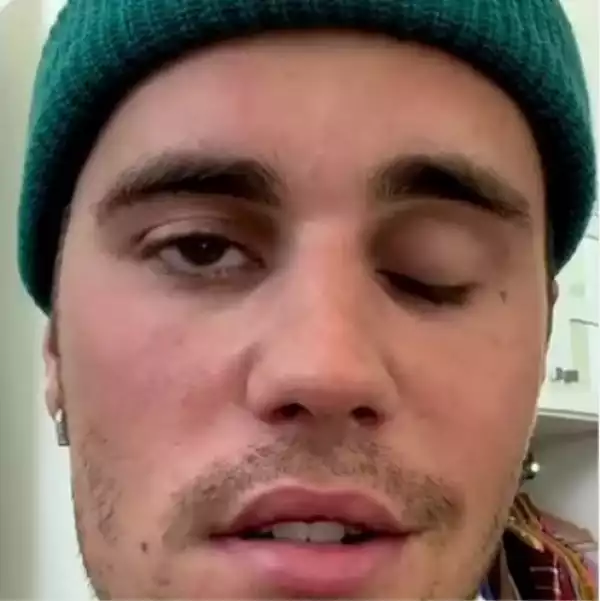 Justin Bieber ​Reveals That Half Of His Face Is Paralyzed After Being Diagnosed With Rare Disorder